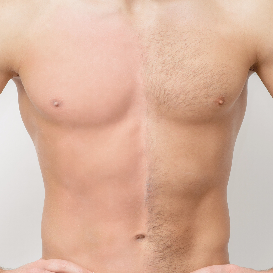 Men's Full Body laser hair Removal x8