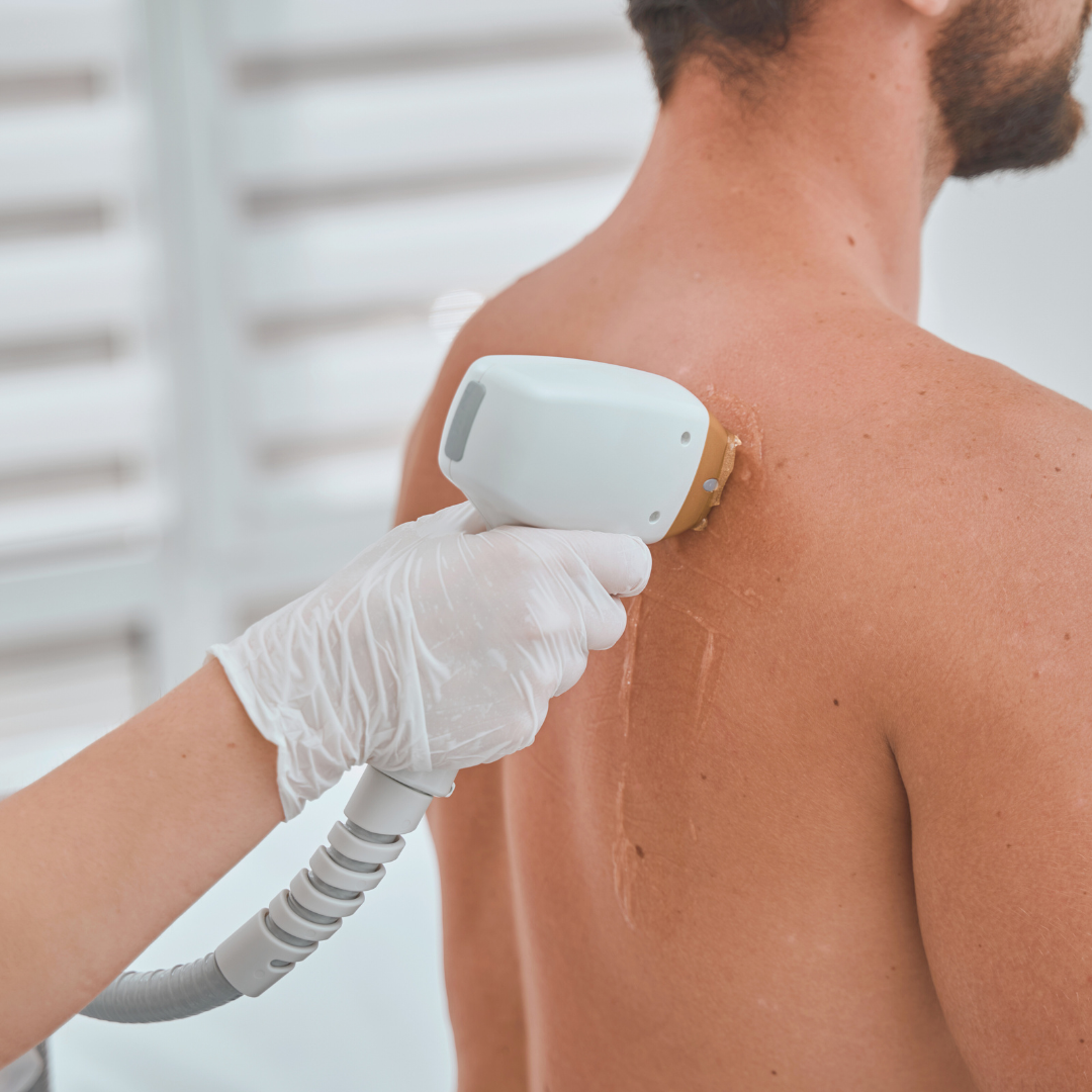 Full Back Laser Hair Removal x1