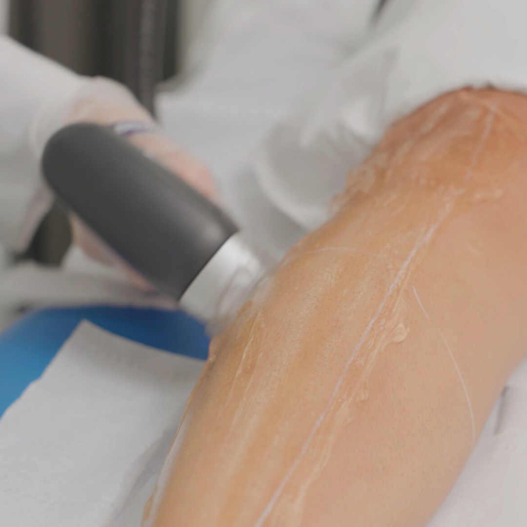 Half Legs (upper or lower) Laser Hair Removal x1