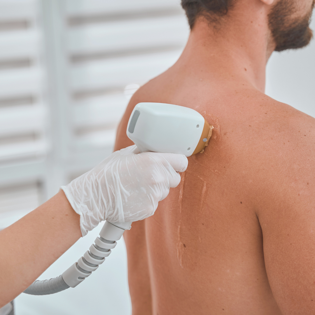 Shoulders Laser Hair Removal x1