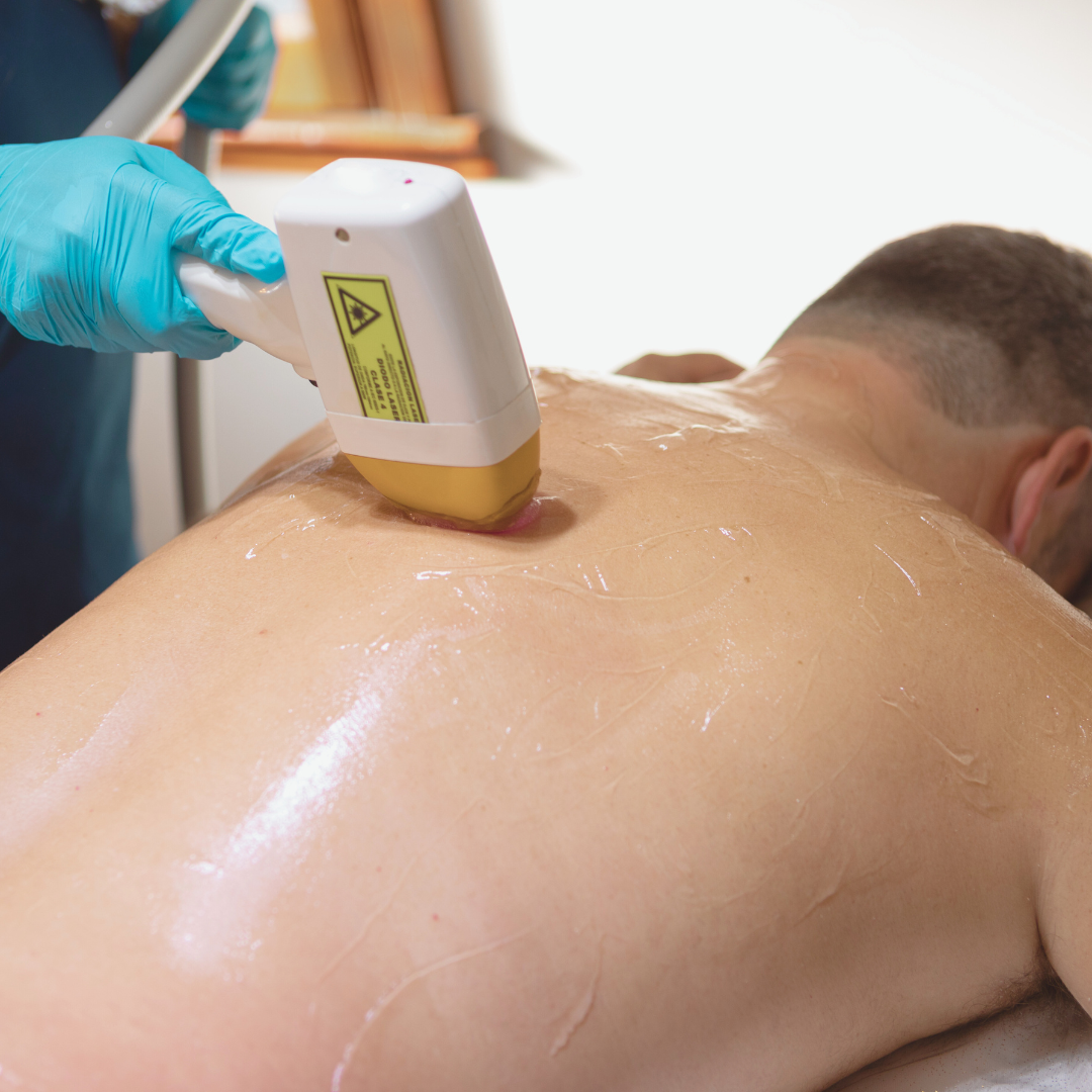 Men's Full Body and Face Laser Hair Removal x1